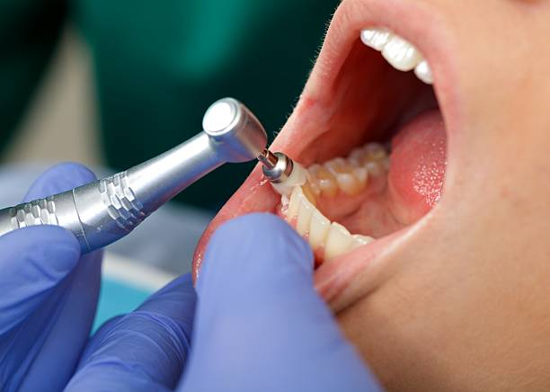 close-up shot of a person's teeth during dental polishing part of a treatment