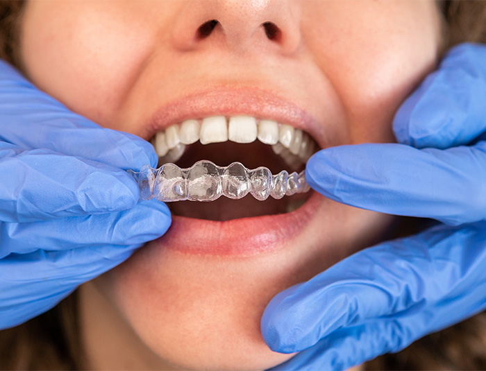 Woman getting Invisalign from the dentist