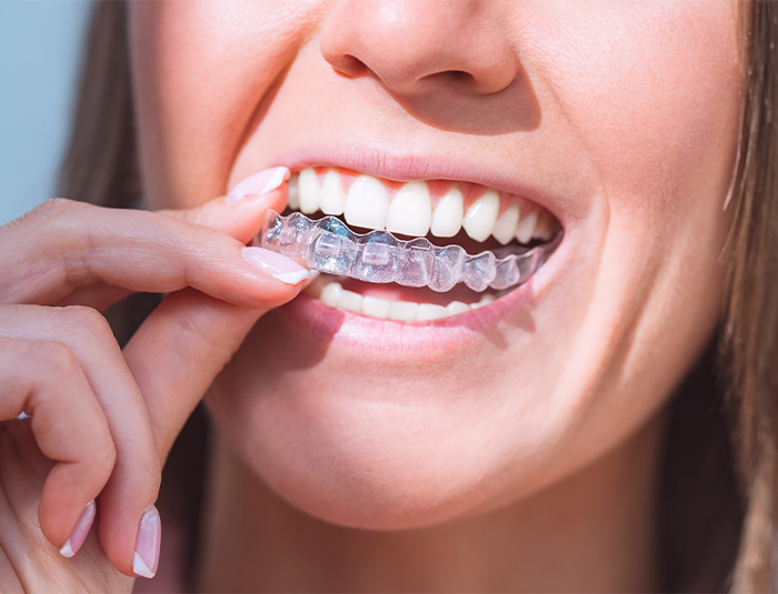 Woman putting in Invisalign aligners