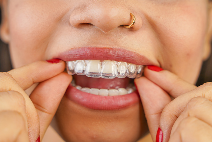 Woman putting in Invisalign