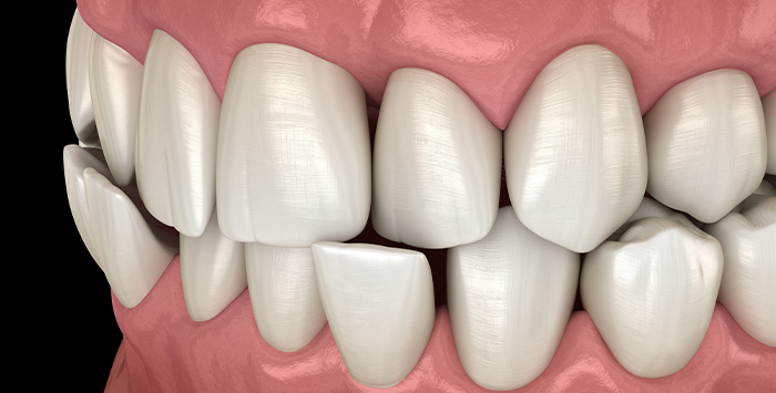 Illustration of a crossbite