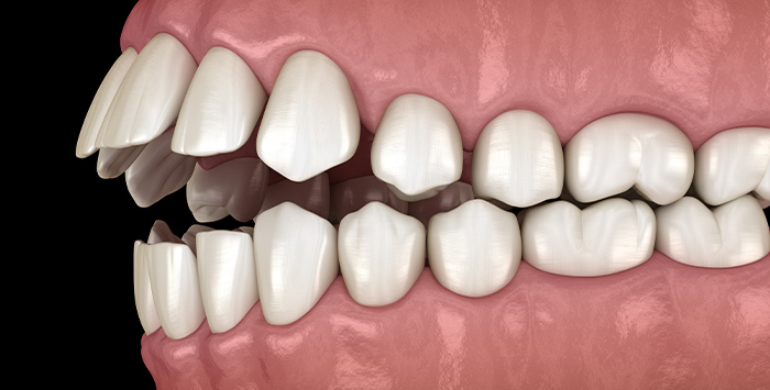 Illustration of an open bite