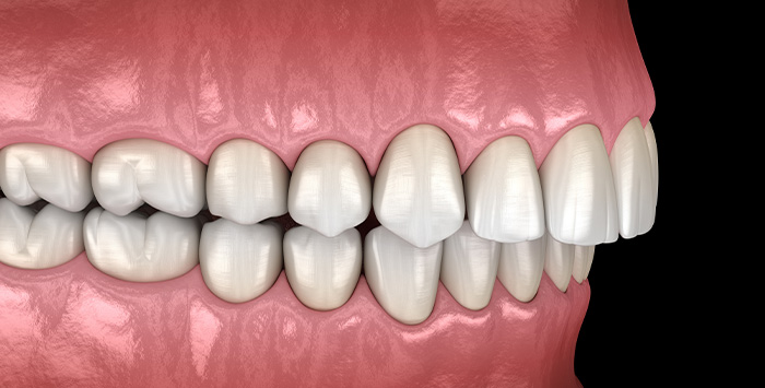 Illustration of an overbite