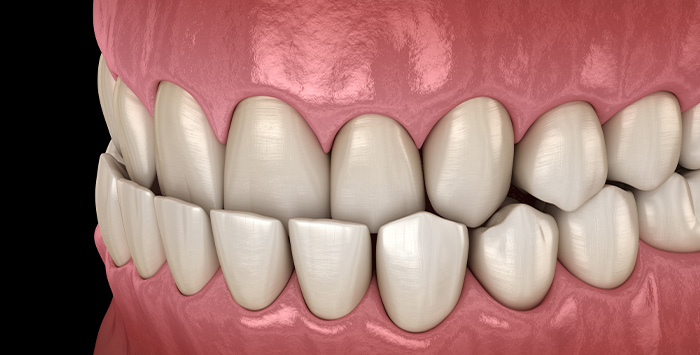 Illustration of an underbite