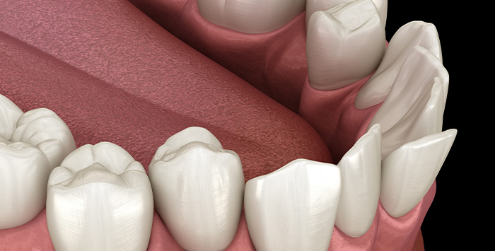 Illustration of crowded teeth