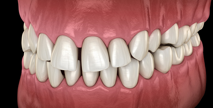 Illustration of gapped teeth