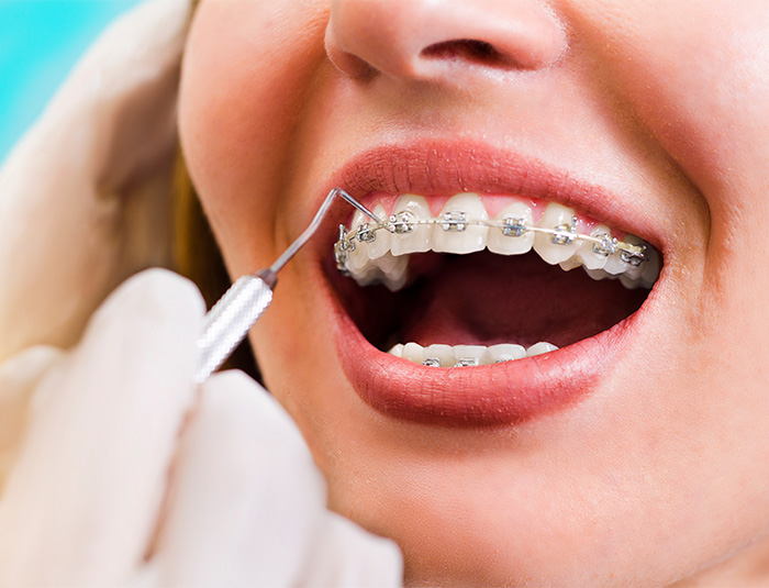 A dentist placing braces on a woman’s teeth.